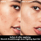 Blemish Breakthrough Acne Fighting Spot Gel