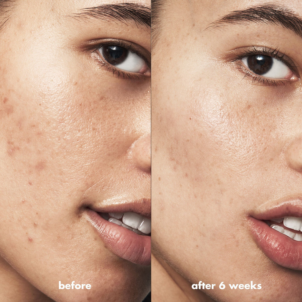Blemish Breakthrough Blemish Control Basics Kit
