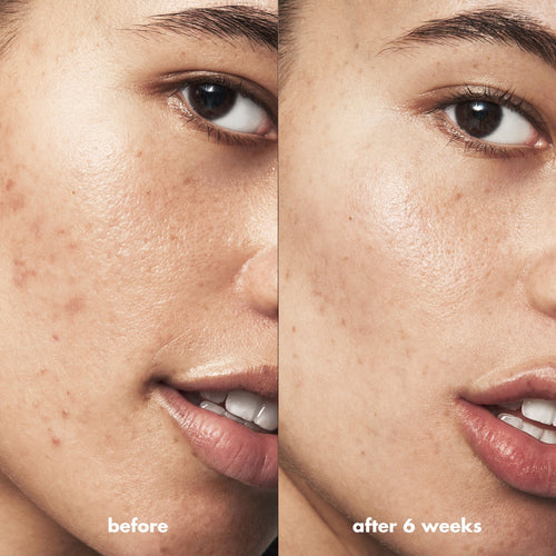 Blemish Breakthrough Blemish Control Basics Kit